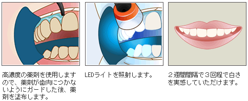 高濃度の薬剤を使用しますので、薬剤が歯肉につかないようにガードした後、薬剤を塗布します。